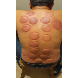 ЦЕНТАР ЗА ХИПНОЗА, МИОФАЦИЈАЛНА ВЕНДУЗИ ТЕРАПИЈА СО МАСАЖА, ХИЏАМА